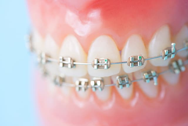 ワイヤー矯正模型