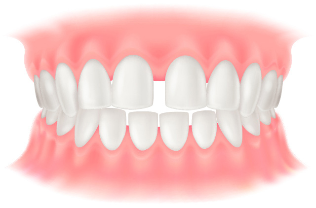 空隙歯列
